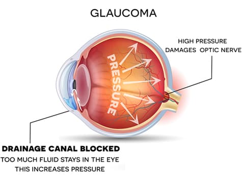 What causes glaucoma