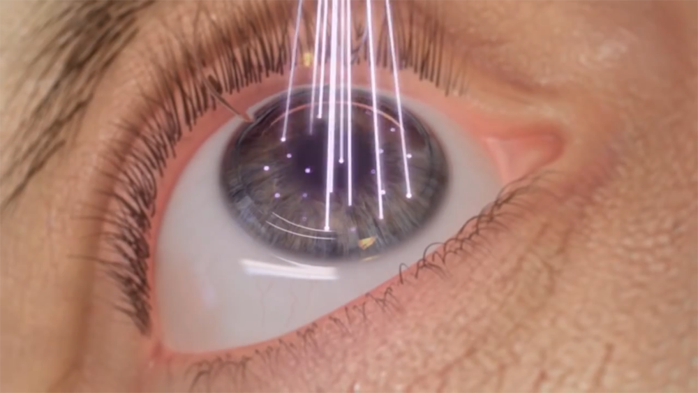 Eye having Lasik laser surgery holes burnt in